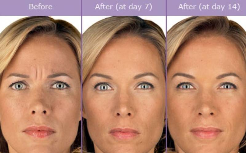 Juvederm washington DC