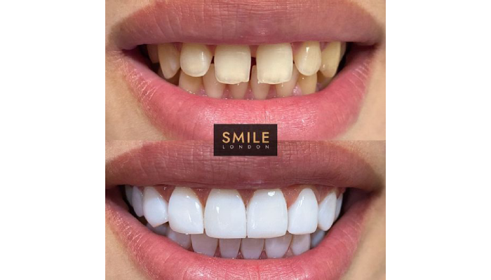 Role Of A Teeth Hygienist In London For Optimal Oral Health