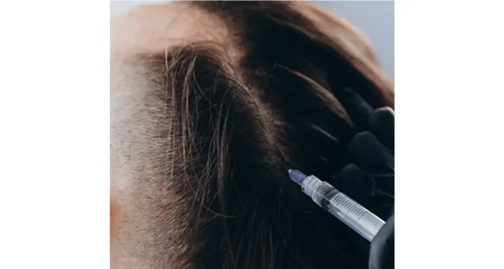 Hair Loss Women Treatment In Istanbul