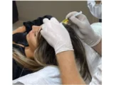 Hair Loss Women Treatment In Istanbul