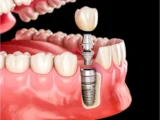 all-on-x dental implants
