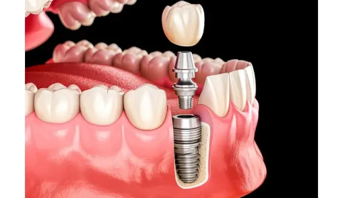 Transform Your Smile With All-On-X Dental Implants Pembroke Pines