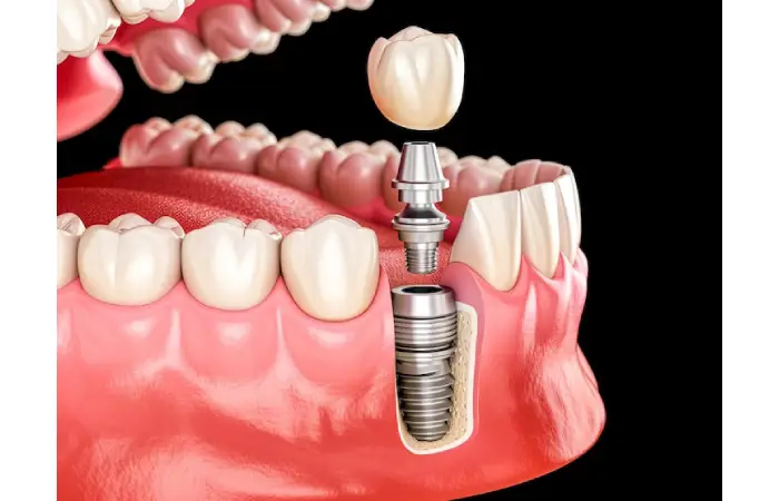 Transform Your Smile With All-On-X Dental Implants Pembroke Pines
