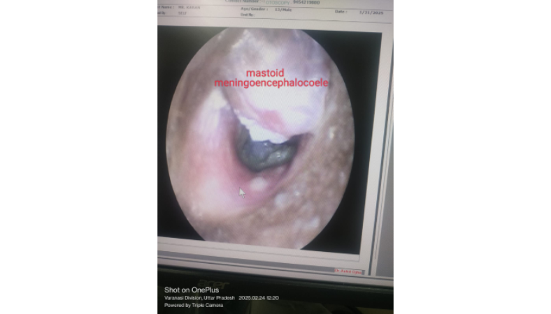 Why Professional Earwax Removal in Varanasi is Better Than Home Remedies?
