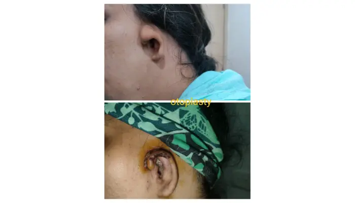 How to Get Effective Earwax Removal in Varanasi for Clear Hearing?